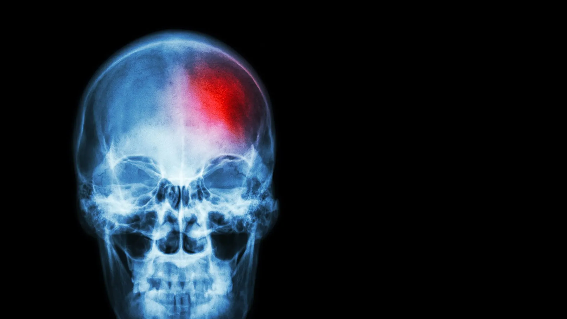 Alabama Brain Injury Attorneys